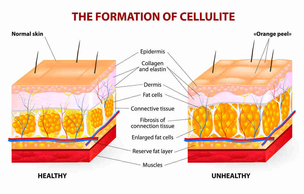 cellulite inner look
