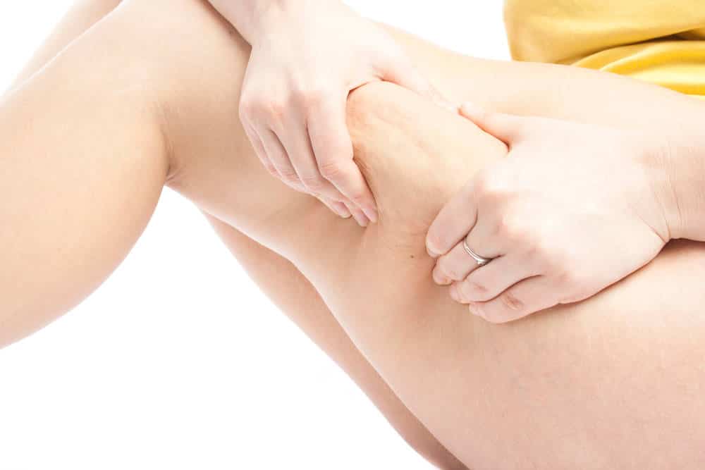 cellulite treatment